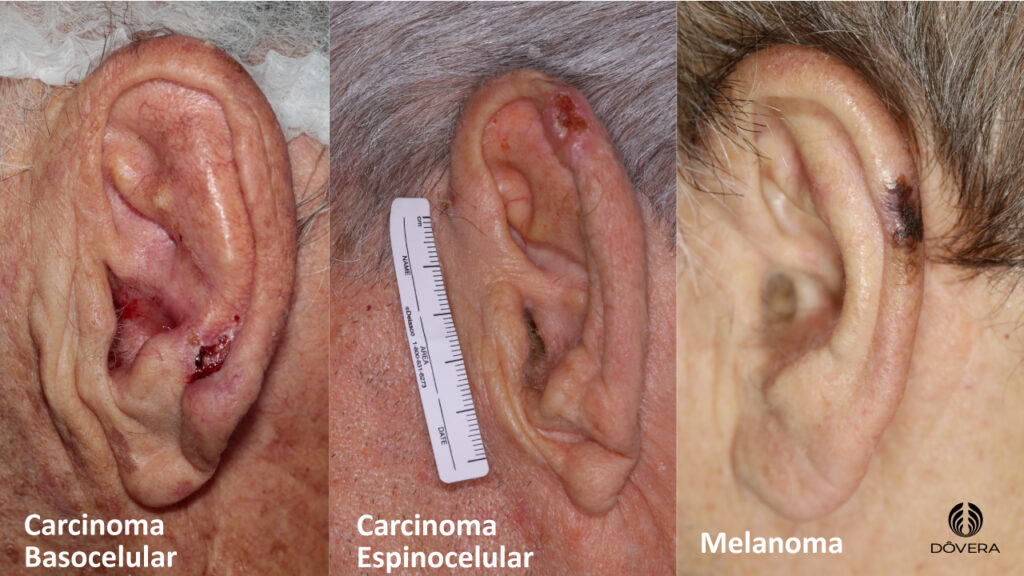 5 ideias de títulos:
1. Câncer de Ouvido: Sinais de Alerta que Você Não Pode Ignorar
2. Neuroma do Acústico vs. Colesteatoma: Entendendo as Diferenças
3. Diagnóstico Precoce do Câncer de Ouvido: A Importância da Otoscopia e RM
4. Tratamento Cirúrgico de Tumores Auriculares: Opções e Recuperação
5. Zumbido Persistente: Um Sintoma de Alerta para Tumores no Ouvido?