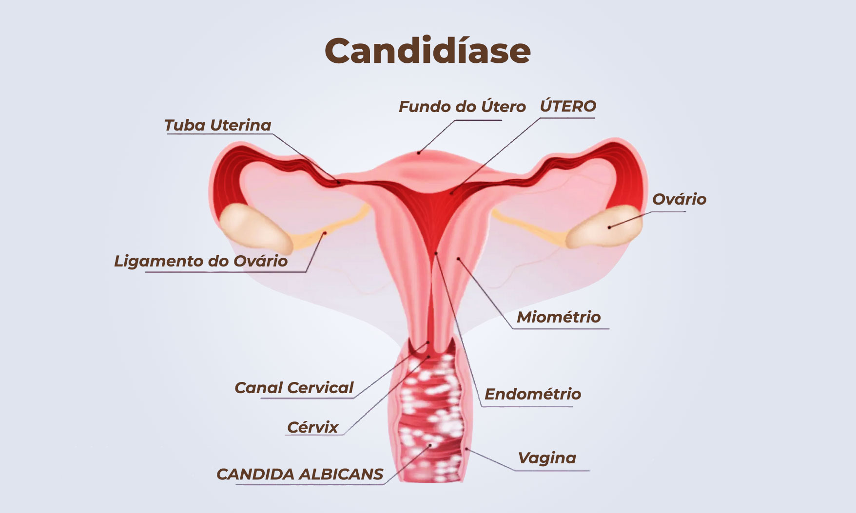 candidiase recorrente tratamento