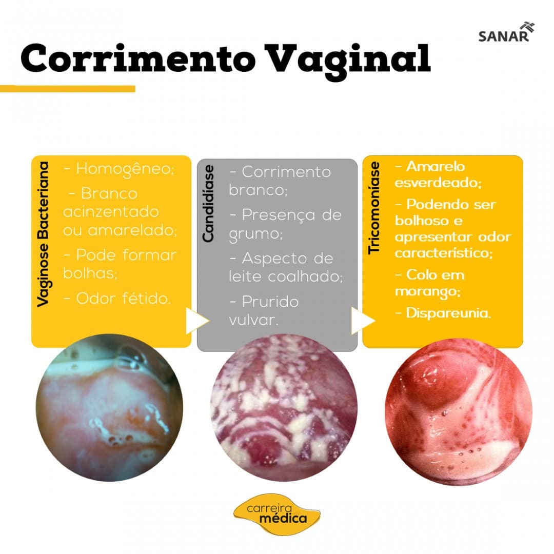 sintomas candidiase recorrente