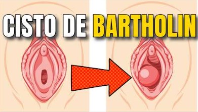 nódulo na vulva