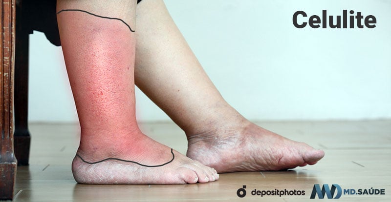 lipedema panturrilha