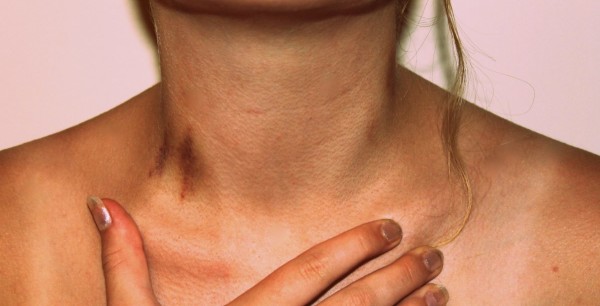 O Que Fazer nas Primeiras 48 Horas Após um Chupão