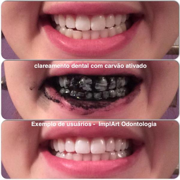 5 ideias de títulos:
1. Clareamento Dental Caseiro: Guia Completo para um Sorriso Mais Branco
2. Os Perigos das Receitas Caseiras para Clarear os Dentes
3. Clareamento Supervisionado por Dentista: A Opção Mais Segura
4. Dicas Essenciais para Manter os Dentes Brancos Após o Clareamento
5. Clareamento Dental: Mitos e Verdades sobre Métodos Caseiros