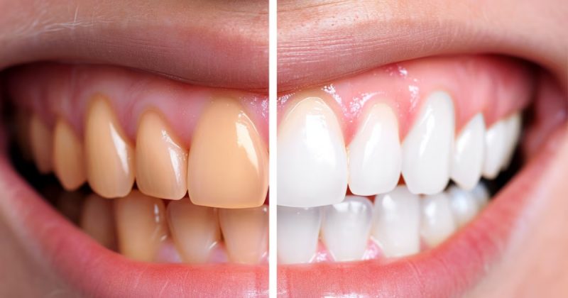 clarear os dentes caseiro