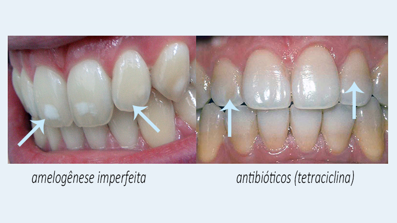 clarear os dentes caseiro
