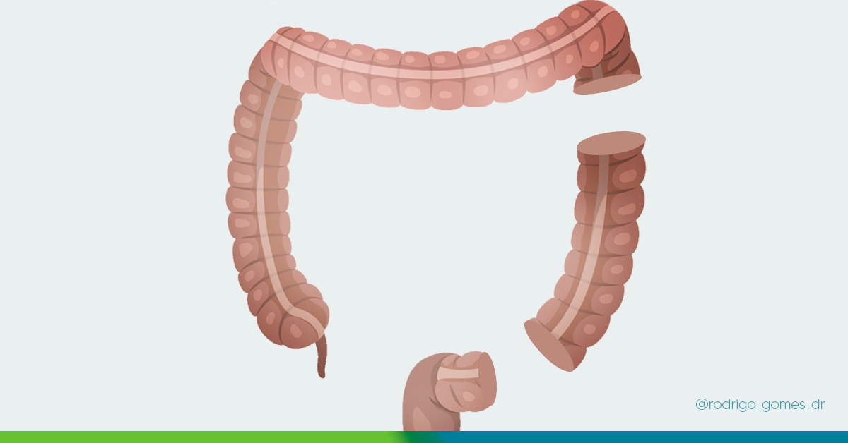 Colectomia: Guia Completo sobre Indicações e Tipos de Cirurgia