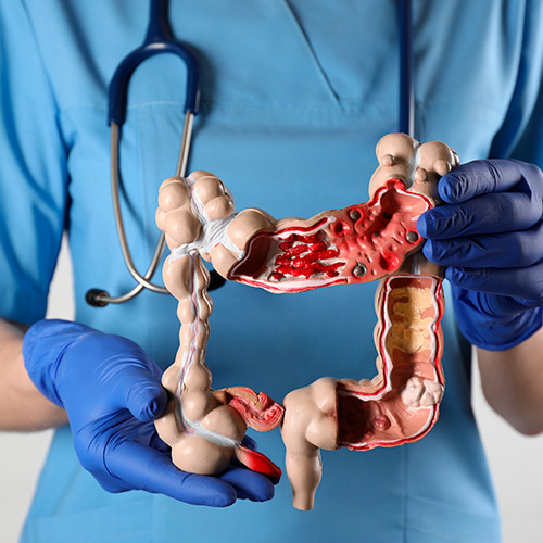 Colectomia: Guia Completo sobre Indicações e Tipos de Cirurgia