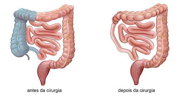 Câncer de Cólon e Colectomia: Entenda o Procedimento e Suas Abordagens