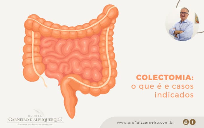 Doenças Inflamatórias Intestinais: Quando a Colectomia se Torna Necessária?