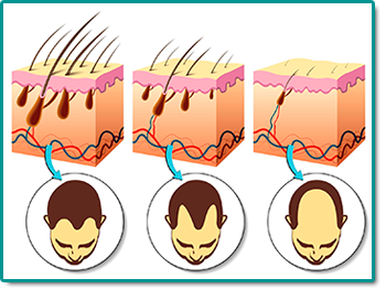 como acabar com a calvice