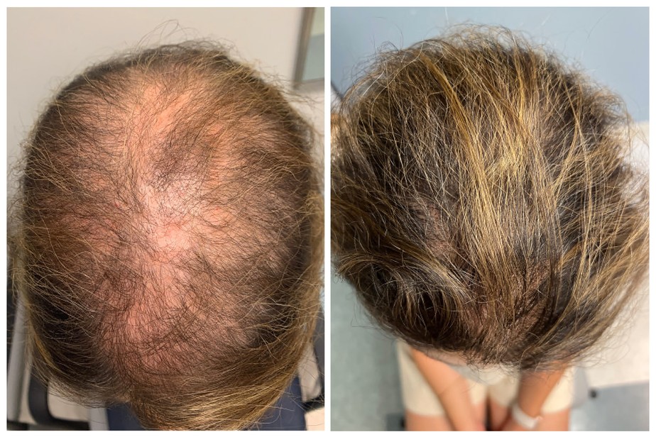 Óleo de Alecrim para o cabelo: Funciona mesmo contra a calvície?