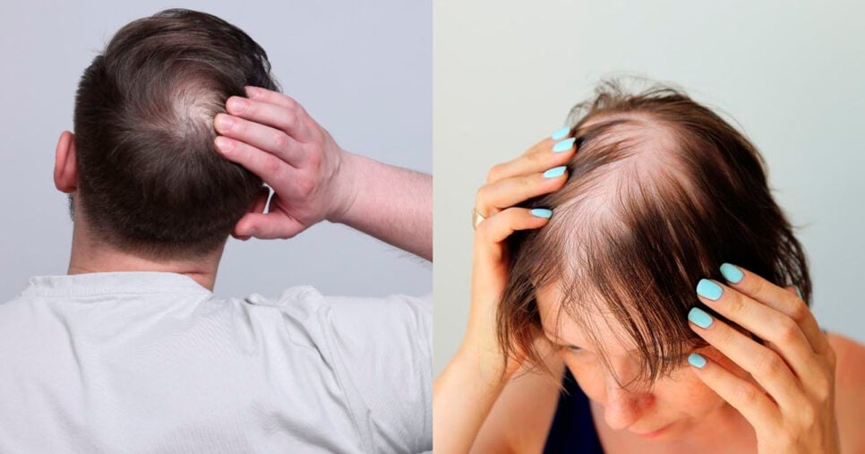 como acabar com a calvice