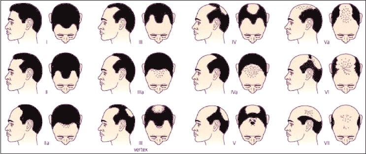 Minoxidil vs. Finasterida: Qual o melhor para sua calvície?
