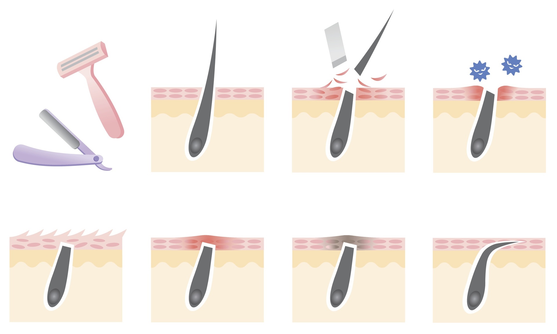 como acabar com os pelos encravados