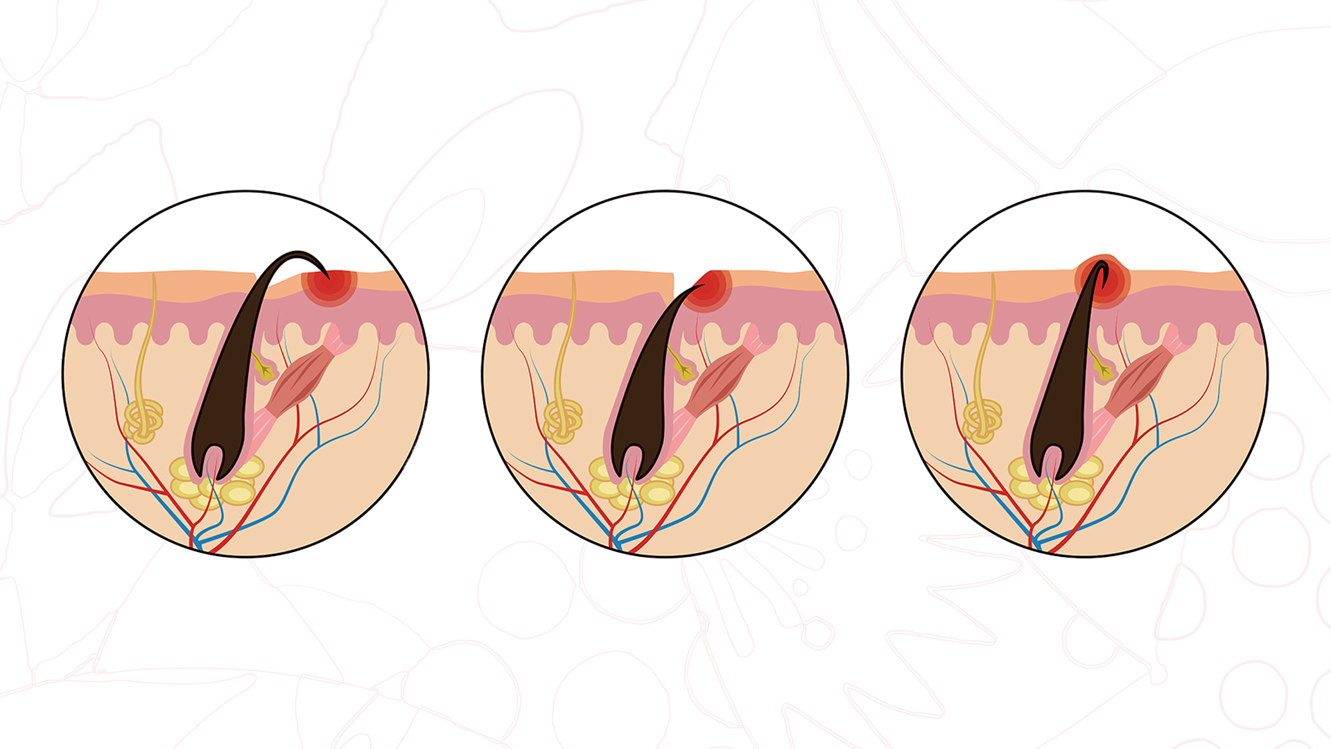 Depilação a Laser vs. Fotodepilação: Qual a Melhor para Pelos Encravados Crônicos?