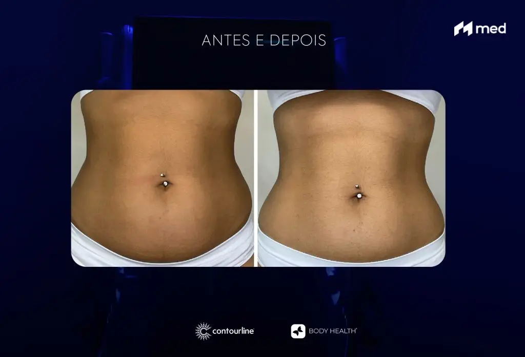 A Importância do Sono na Definição Muscular