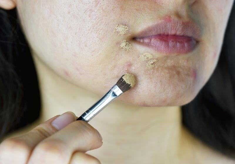 Como tratar espinhas rapidamente