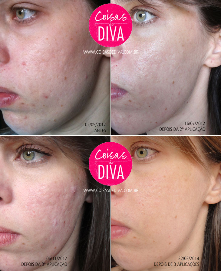 Maquiagem para festa com espinhas