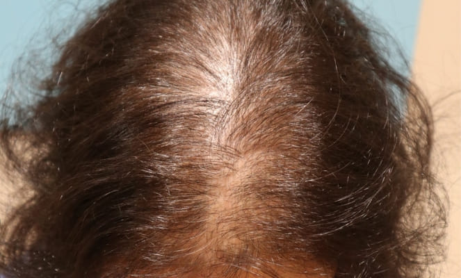 Alopecia Feminina: Causas