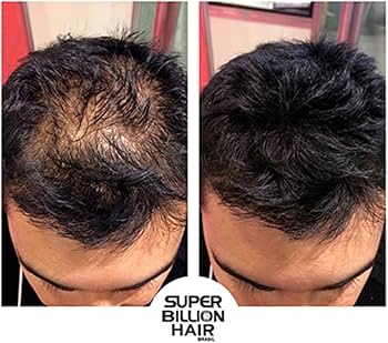 Alopecia Feminina: Causas