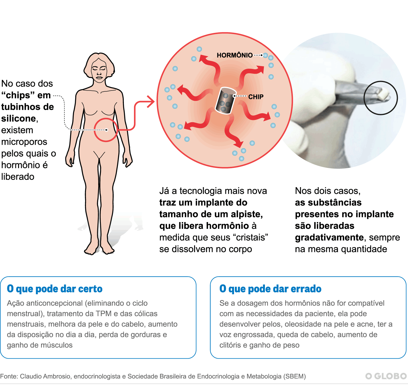 Como funciona o chip da beleza vs chip contraceptivo