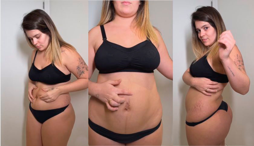 Diástase Abdominal: Como Identificar e Tratar no Pós-Parto