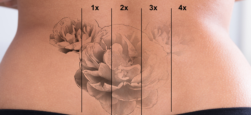 melhor tratamento para remover tatuagem