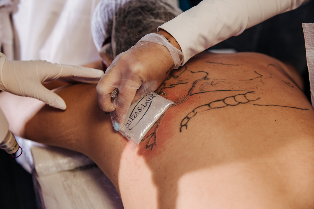 remoção de tatuagem como tirar e cuidados