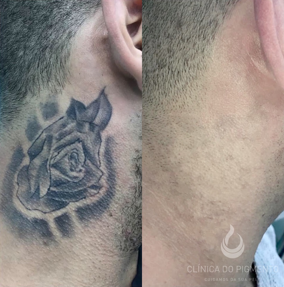 laser para remoção de tatuagens funciona
