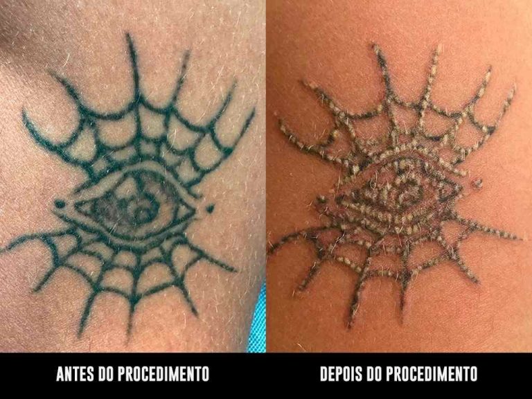 é mais fácil remover tatuagem recente ou antiga