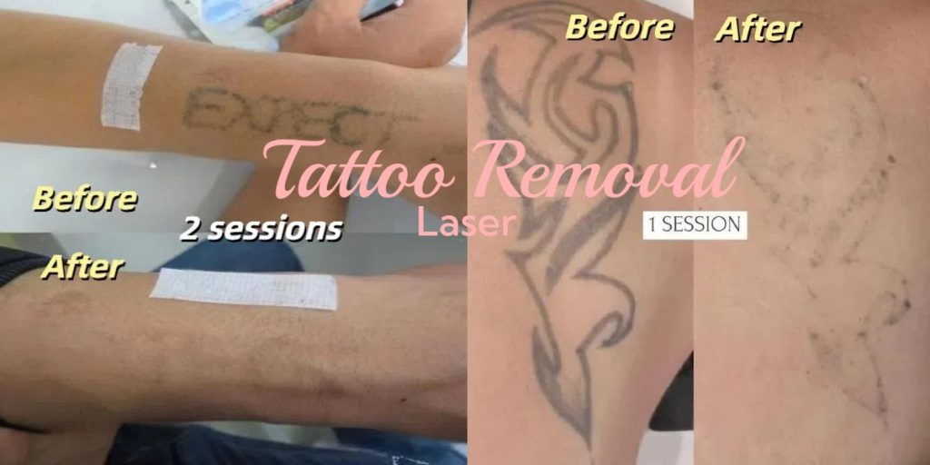 compare 4 métodos para remoção de tatuagem