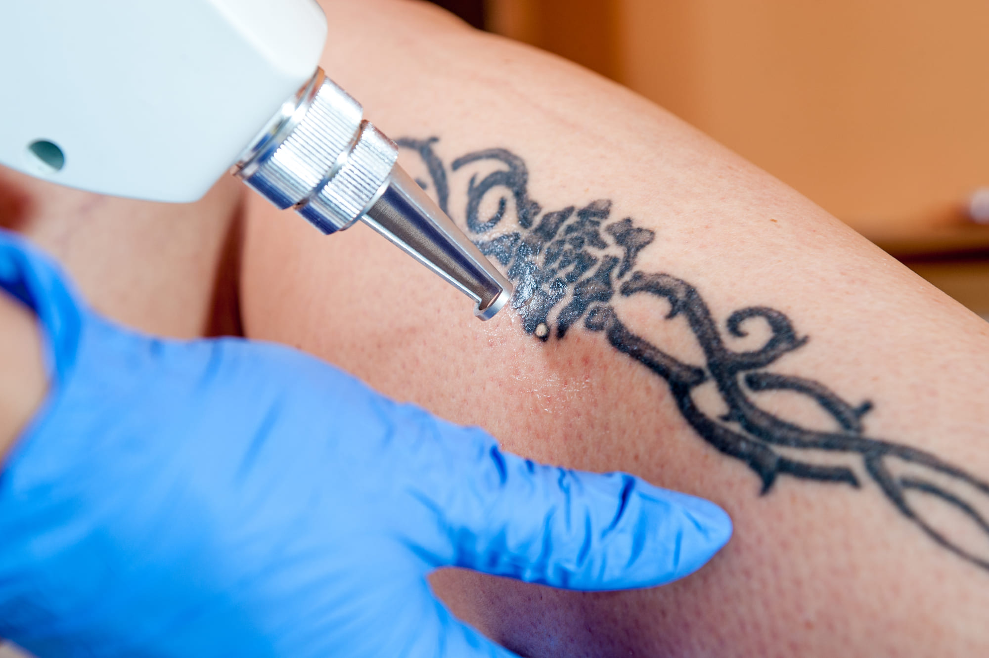 remover tatuagens é possível