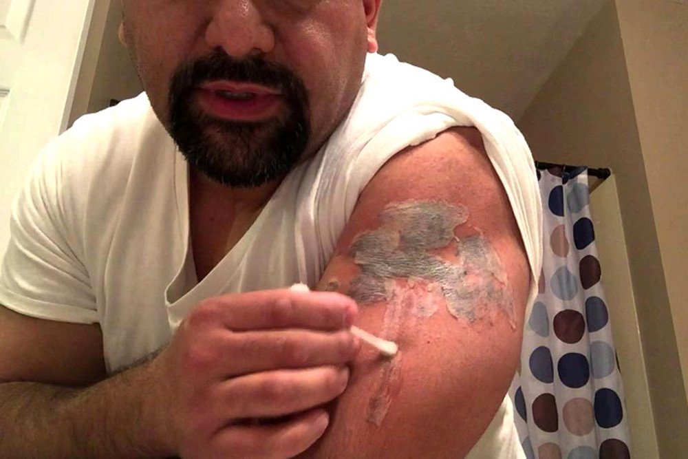 remoção de tatuagem como tirar e cuidados