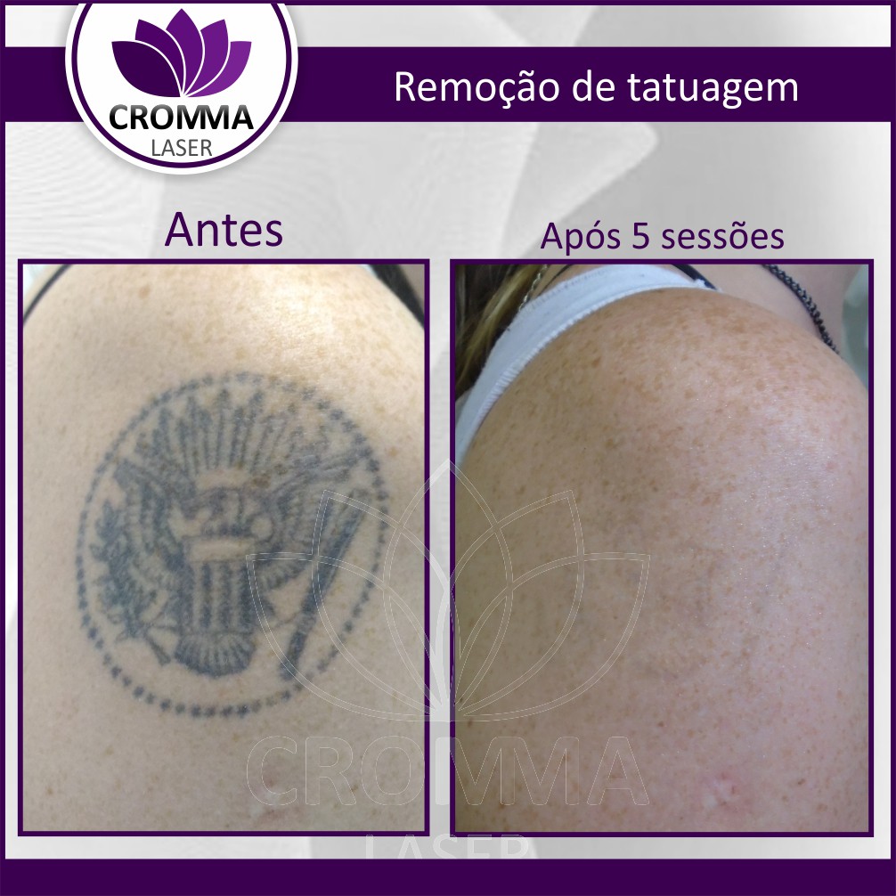laser para remoção de tatuagens funciona