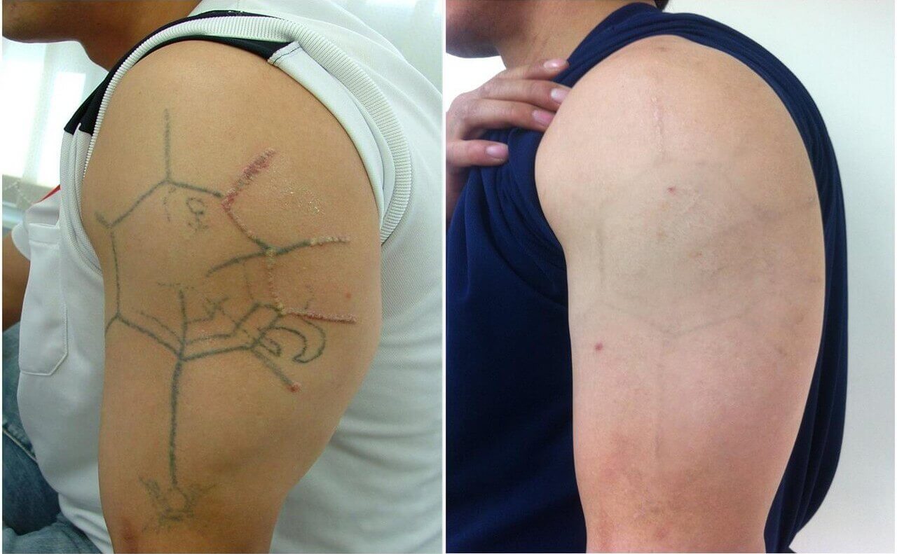 compare 4 métodos para remoção de tatuagem