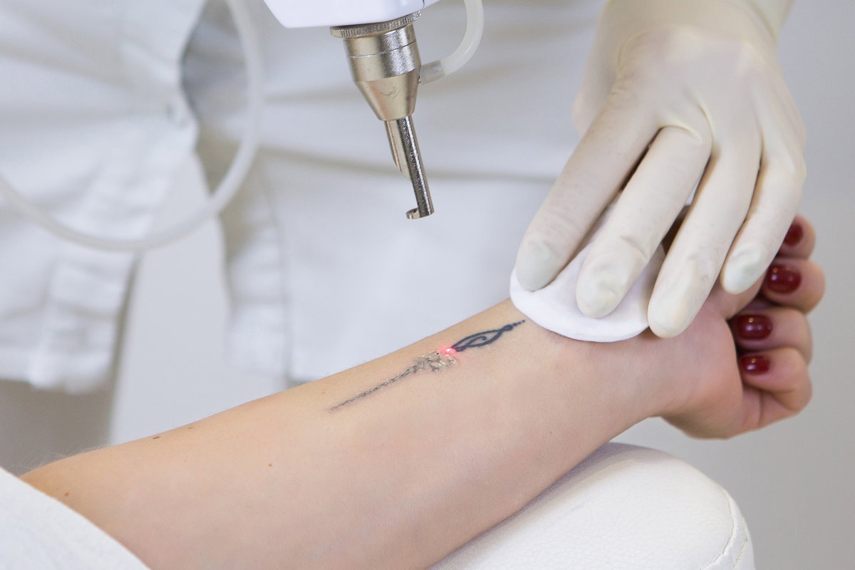 remover tatuagens é possível