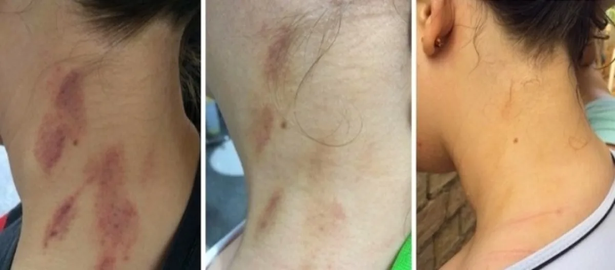 Dicas de Acessórios para Disfarçar Marcas no Pescoço