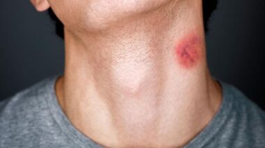 Como Usar Maquiagem para Cobrir Marcas Indesejadas