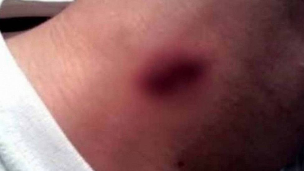 Dicas de Acessórios para Disfarçar Marcas no Pescoço