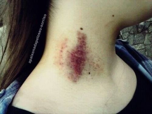 Dicas de Acessórios para Disfarçar Marcas no Pescoço