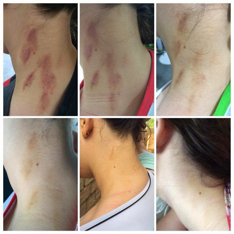 5 Mitos e Verdades sobre Chupões no Pescoço