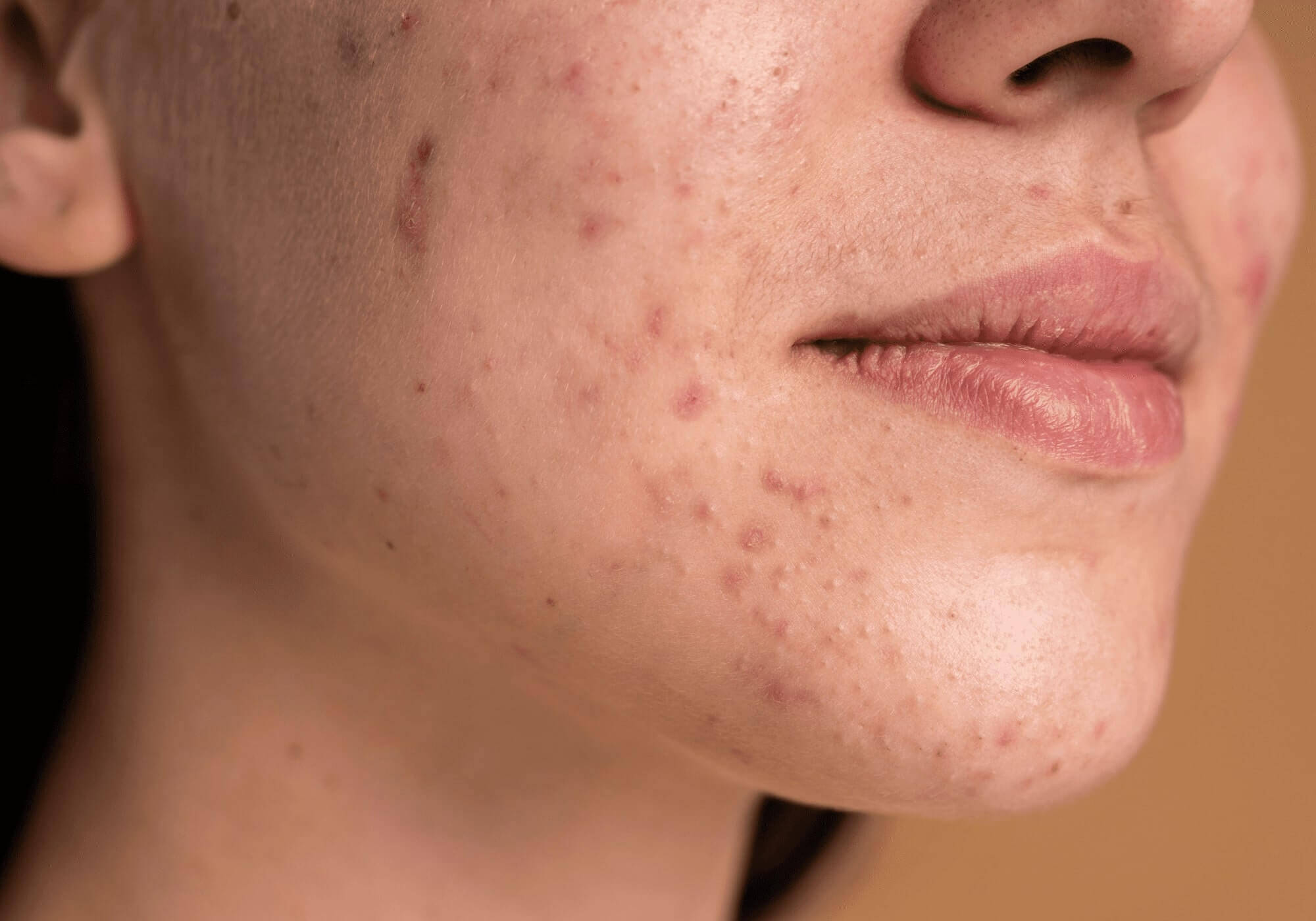 5 ideias de títulos:
1. Guia Completo: Como Remover Cravos de Forma Segura e Eficaz
2. Os Melhores Ativos para Combater Cravos: Ácidos e Retinoides Explicados
3. Limpeza de Pele em Casa: Técnicas e Receitas Caseiras para Cravos
4. Limpeza de Pele Profissional vs. Caseira: Qual a Melhor Opção para Cravos?
5. Prevenção de Cravos: Rotina de Cuidados Essenciais para uma Pele Livre de Imperfeições