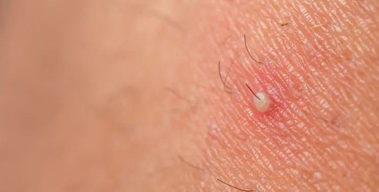 Depilação a Laser e Foliculite: Vale a Pena o Investimento?