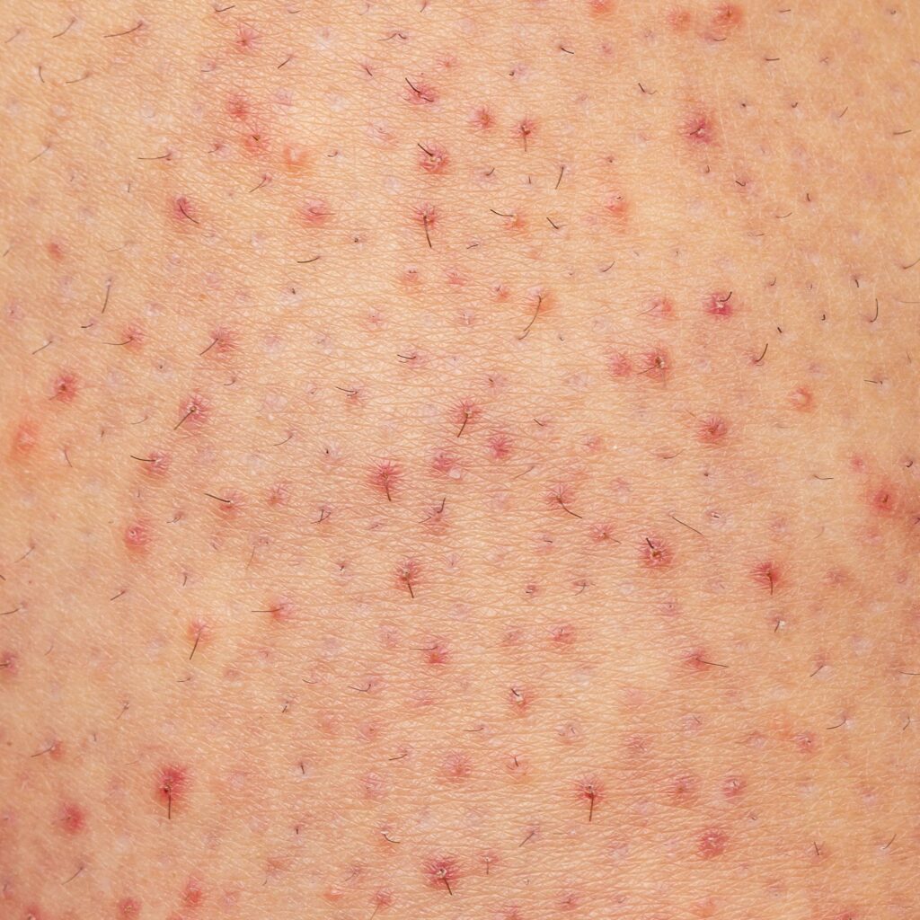 Foliculite na Barba e Região Íntima: Dicas Específicas de Prevenção e Tratamento