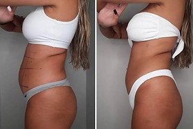 Criolipólise para gordura localizada preço