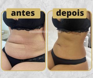 Guia Completo: Como Escolher a Melhor Clínica de Criolipólise