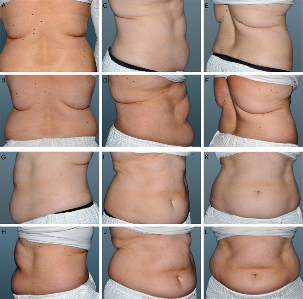 Criolipólise e Pós-Crio: Maximizando Seus Resultados