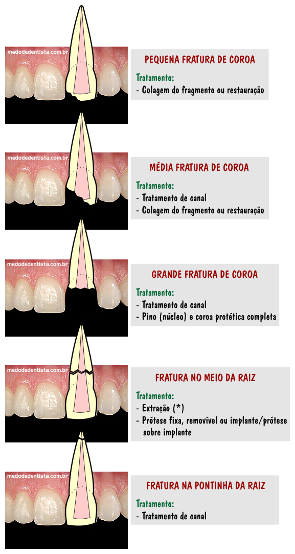 5 ideias de títulos:
1. Dente Trincado: Guia Completo de Causas