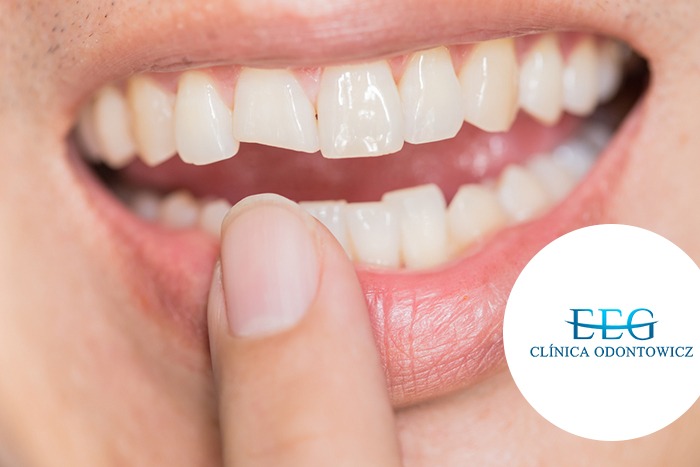 Sintomas e Tratamentos
2. Síndrome do Dente Rachado: O Que Fazer Para Evitar a Perda Dental
3. Dor ao Mastigar? Entenda as Causas e Soluções Para Dentes Trincados
4. Bruxismo e Dentes Trincados: Como Proteger Sua Saúde Bucal
5. Dente Rachado: Quando a Restauração ou a Extração é Necessária?