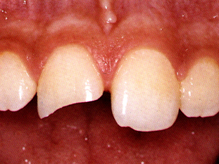 Sintomas e Tratamentos
2. Síndrome do Dente Rachado: O Que Fazer Para Evitar a Perda Dental
3. Dor ao Mastigar? Entenda as Causas e Soluções Para Dentes Trincados
4. Bruxismo e Dentes Trincados: Como Proteger Sua Saúde Bucal
5. Dente Rachado: Quando a Restauração ou a Extração é Necessária?
